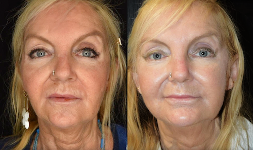 Mid Face Thread Lift Before After Mississauga Oakville
